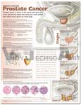 Understanding Prostate Cancer Anatomical Chart